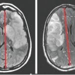 Safety and efficacy of intravenous glyburide on brain swelling after large hemispheric infarction (GAMES-RP): a randomised, double-blind, placebo-controlled phase 2 trial
